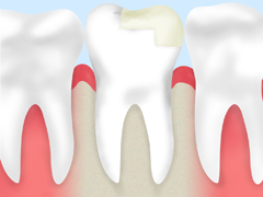 虫歯の治療痕が痛む？