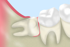 歯が痛い原因は「親知らず」かもしれません
