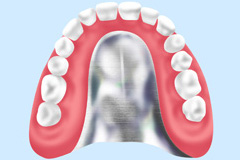金属床義歯（自費）