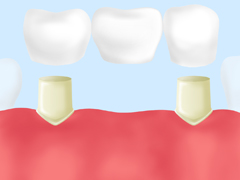 ジルコニアブリッジ（自費）