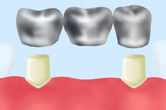 金属ブリッジ（保険）