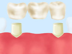 ハイブリッドセラミックブリッジ（自費）