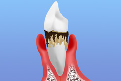 出血、ネバつき、口臭……それは歯周病のサインかもしれません